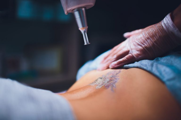 laser Tattoo removal