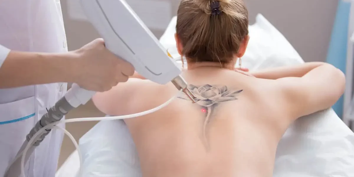 Laser Tattoo Removal by RAW Aesthetics and Wellness in Salt Lake City UT